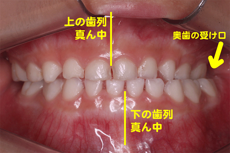 子どもの矯正治療例