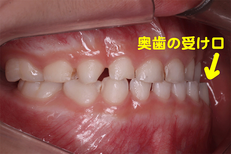 子どもの矯正治療例