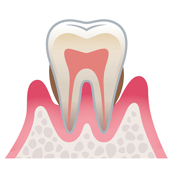 軽度〜中等度歯周炎